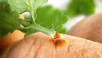 Come ottenere una verruca con un Celandine