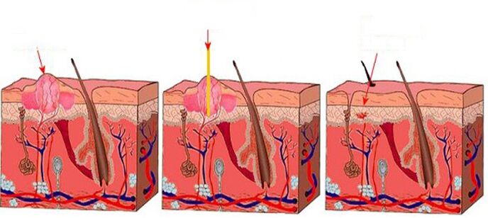 Come funziona il laser sui papillomi