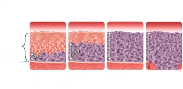 displasia cervicale