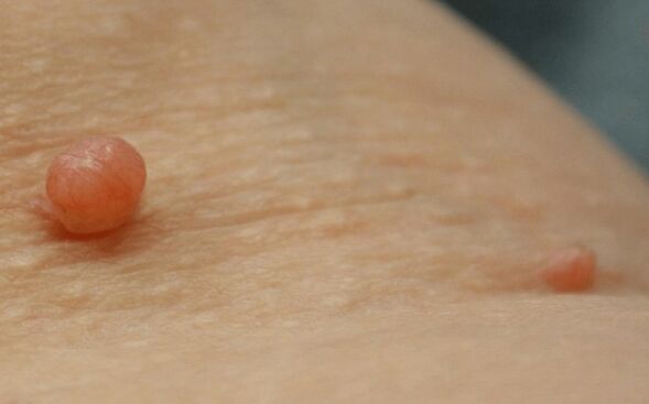 papilloma sul corpo
