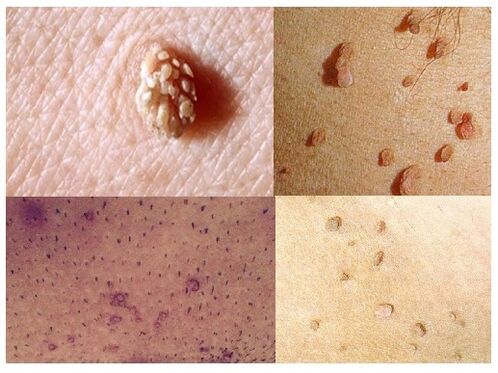 verruche genitali sul corpo