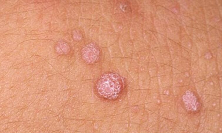 L'HPV porta alla comparsa di papillomi cutanei