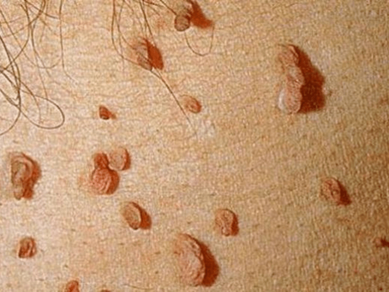 Papillomi sul corpo