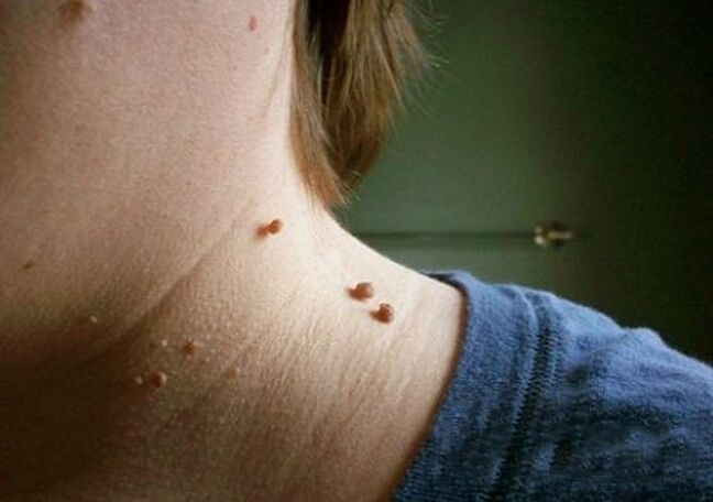 papillomi sul collo