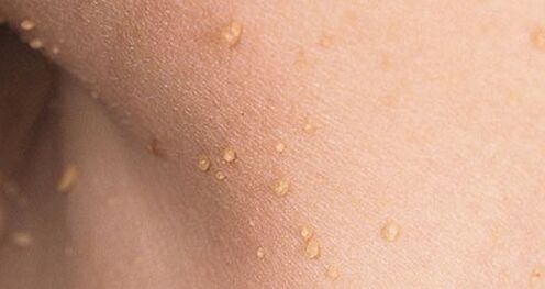 Come si manifesta il papillomavirus umano