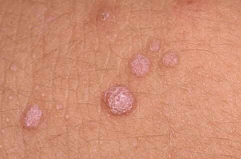 Sintomi del papillomavirus umano