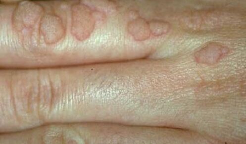 papillomavirus umano sulle mani