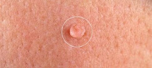 verruche genitali sul corpo