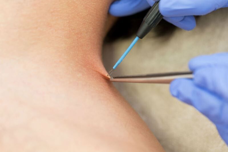 La procedura per rimuovere il papilloma mediante elettrocoagulazione