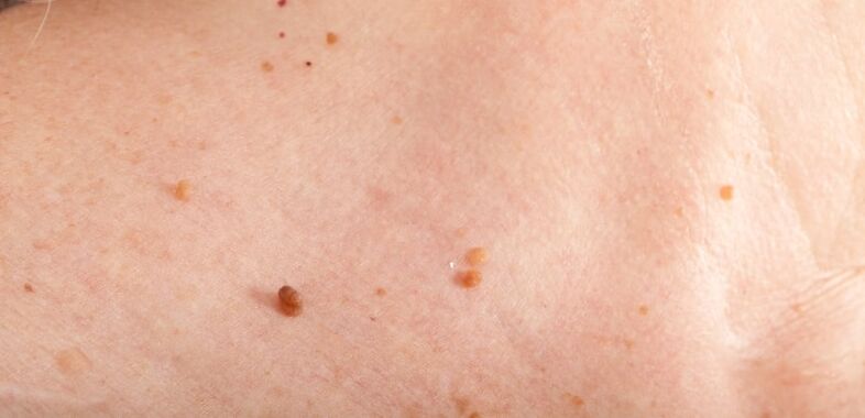Papillomi sul corpo
