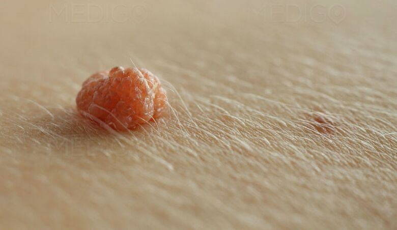 papilloma sulla pelle