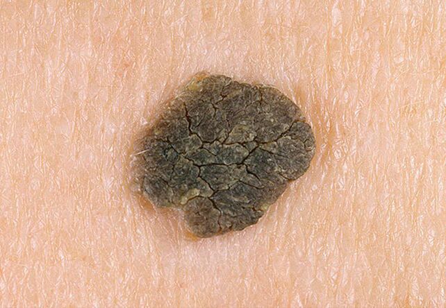 verruca sulla pelle