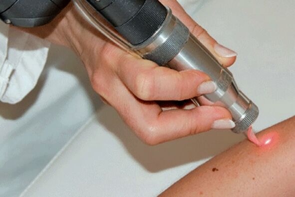 Rimozione laser del papilloma