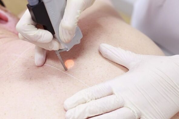 Un metodo popolare per rimuovere i papillomi con un laser