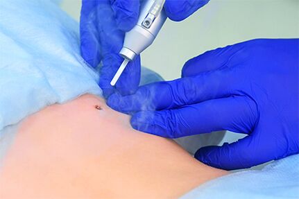rimozione del papilloma laser