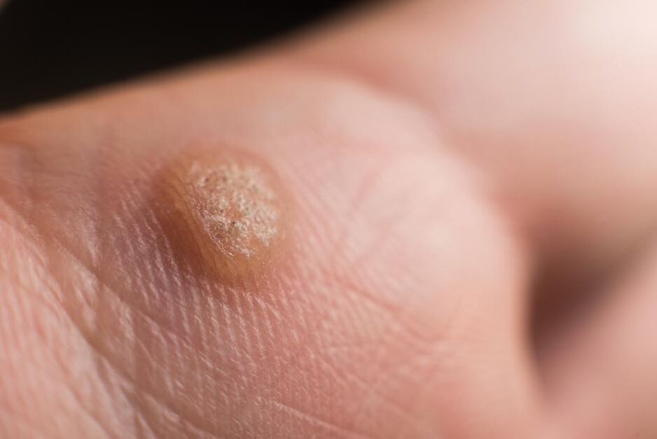 papillomavirus umano sulla pelle