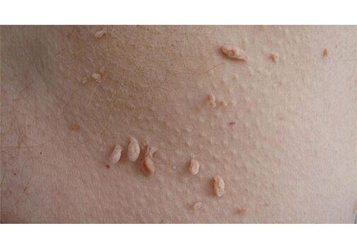 Un segno di infezione da HPV è la comparsa di papillomi sul corpo