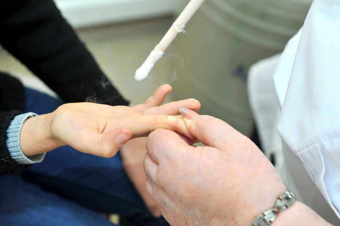periodo di recupero dopo la rimozione della verruca