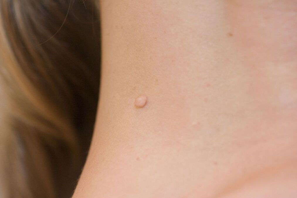 Sintomi dell'HPV