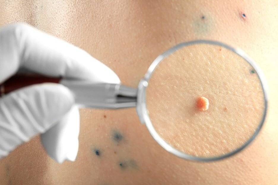 Trattamento dell'HPV