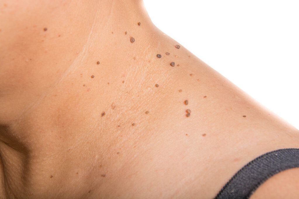 complicanze dell’HPV