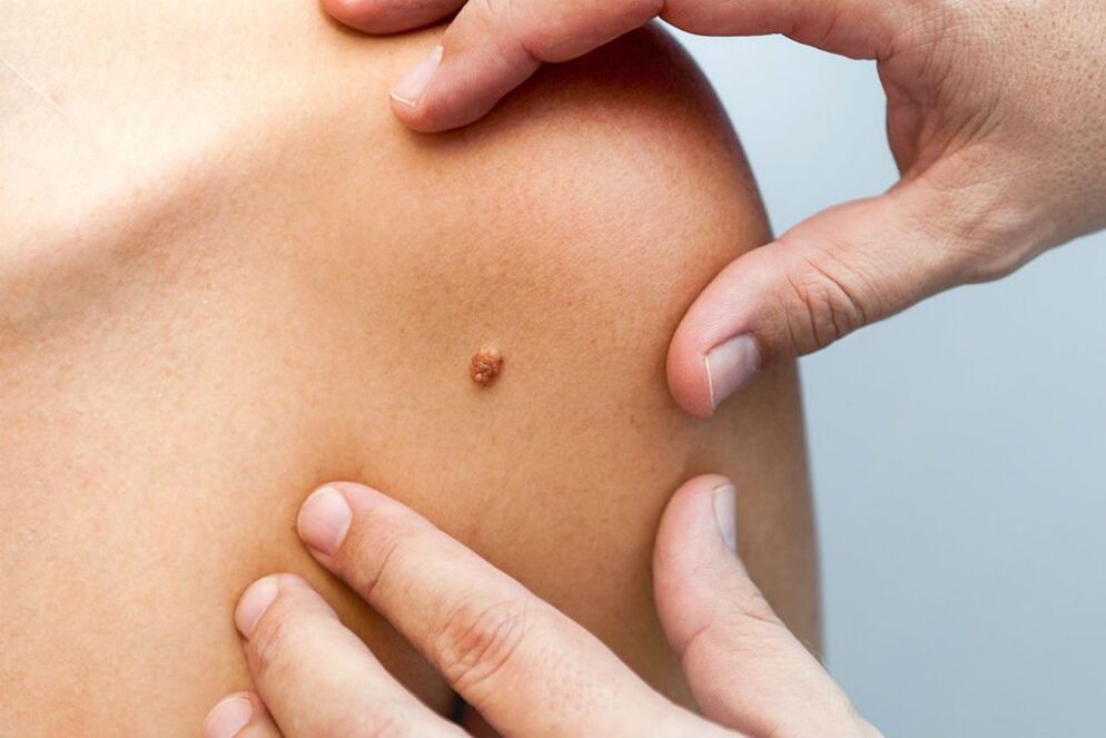 papillomi sul corpo umano