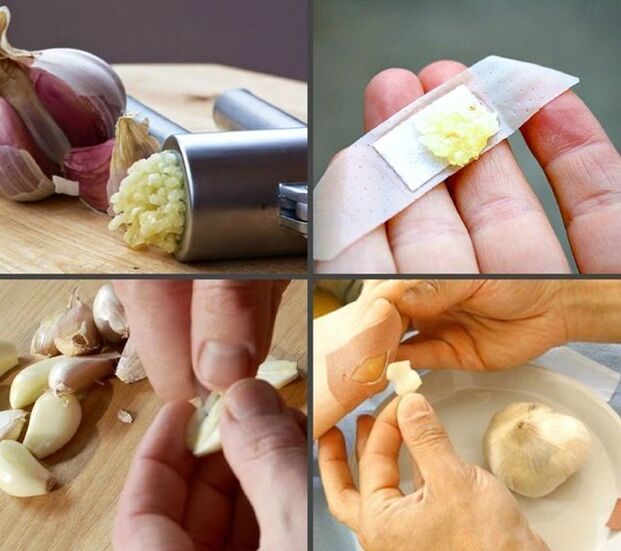 trattamento dei papillomi sulle gambe