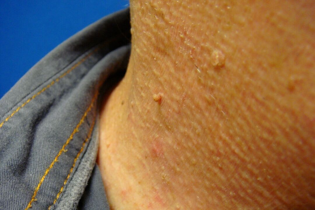 papillomi sul collo umano