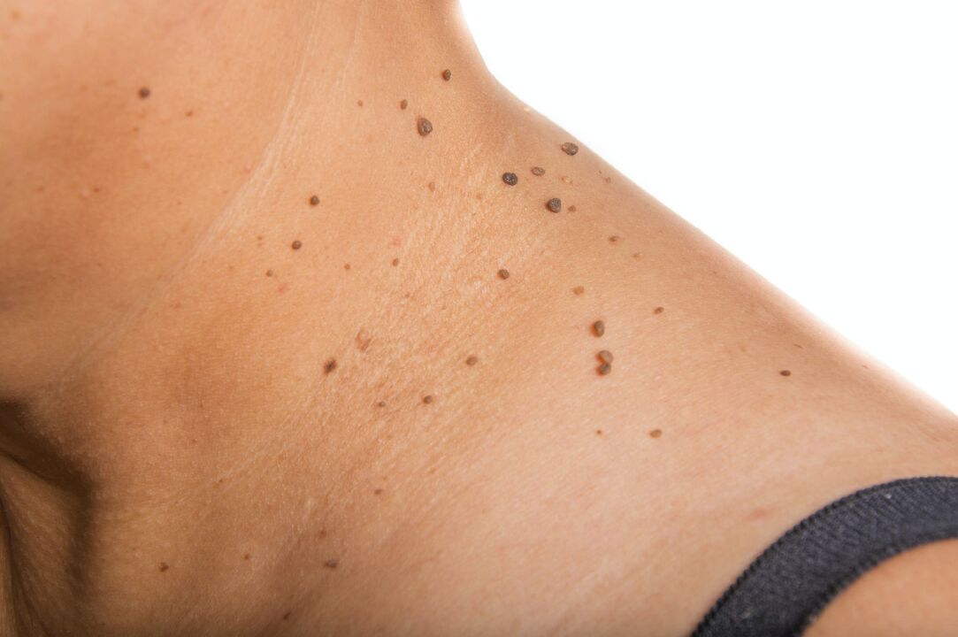 una manciata di papillomi sul collo