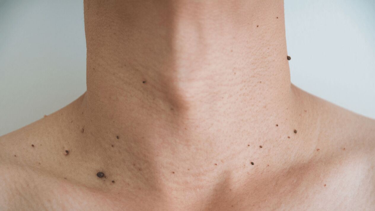 trattamento con crema Keramin per papillomi su collo e torace