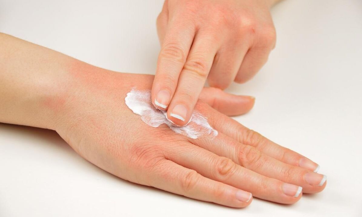 trattamento della psoriasi con crema Keramin